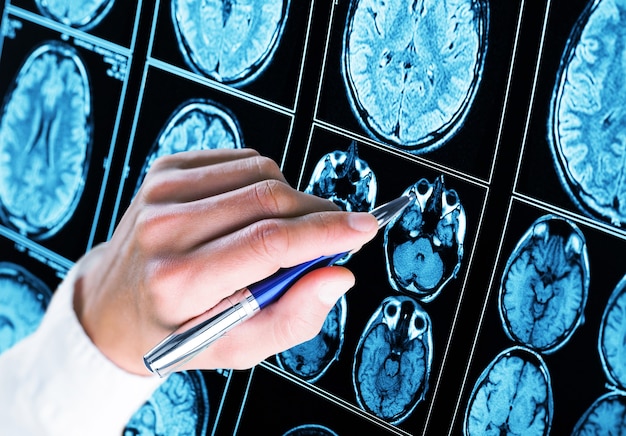 Medical Malpractice — Severe Brain Injuries